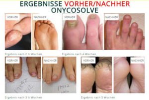 Stinkende Schuhe - Onycosolve: DAS Mittel gegen Fuß- und Nagelpilz